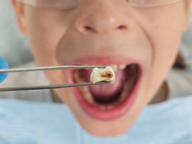 Best Emergency Dental Extractions in Pleasant Grove, AL